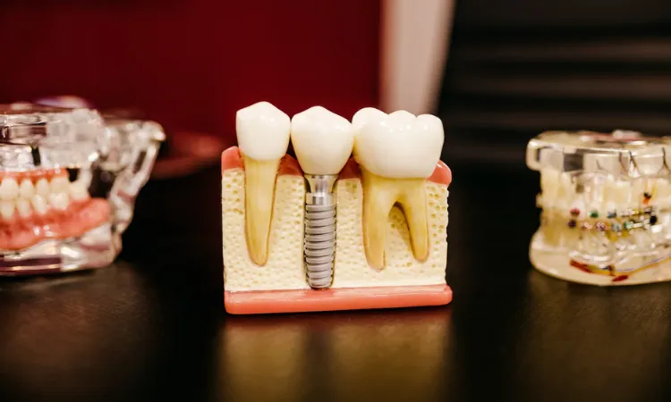 dental implants