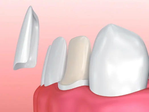 dental veneers