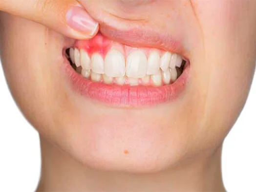 gum diseases